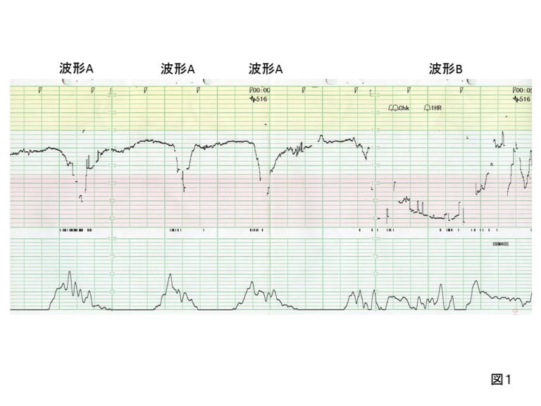 西日本産-分娩介助トレーニングに使える胎児心音付きCTG波形 XIMPr 