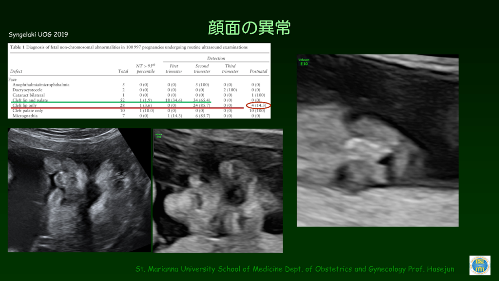 41.胎児超音波（胎児精密超音波検査）はどこまでみるべきか？ – 日本 